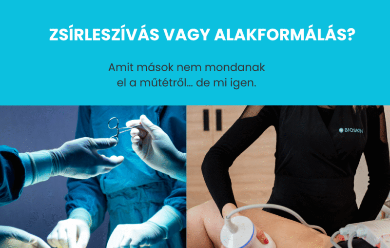 Zsírleszívás helyett kavitációs alakformálás – mit érdemes tudni? 62 zsirleszivas helyett kavitacio